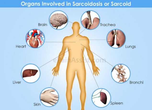 sarcoidios